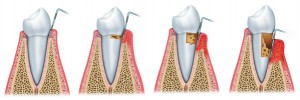 Sequence of Periodontitis